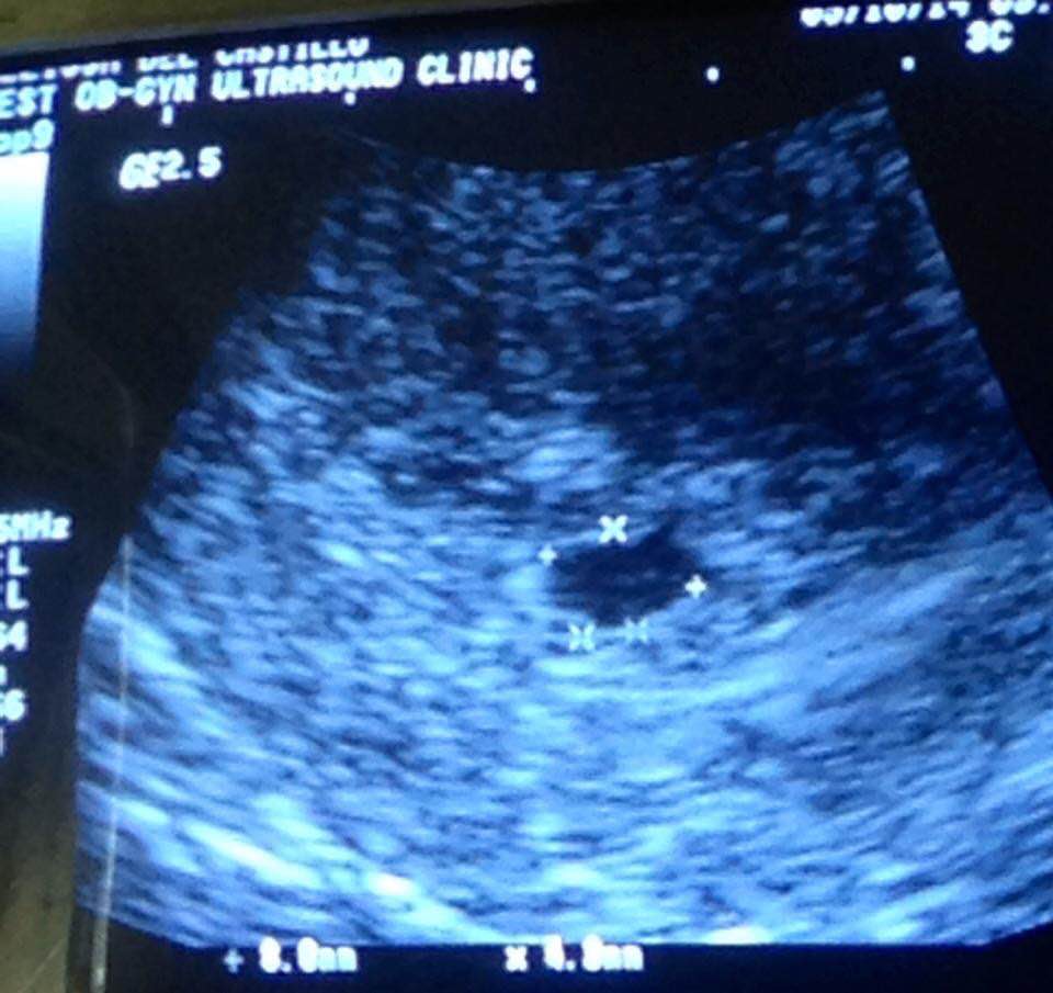 Ultrasound of Baby Aiyah